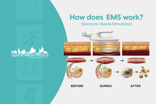 EMS treatment for post pregnancy weight loss treatment Preston