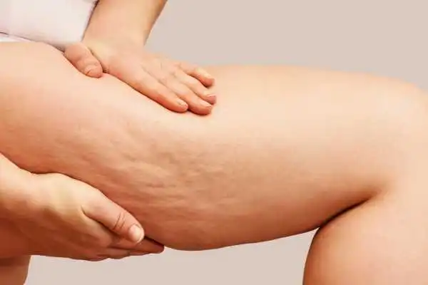Image of woman showing leg with cellulite Preston