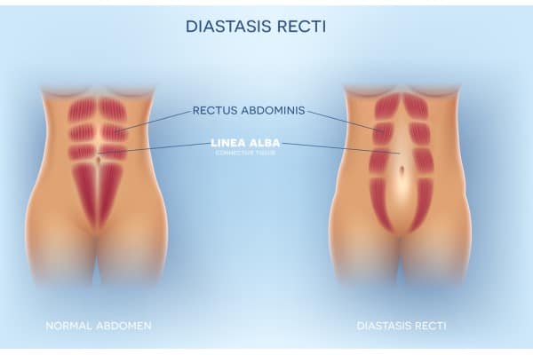 What Non-Surgical Options Are Available for Diastasis Recti Preston?