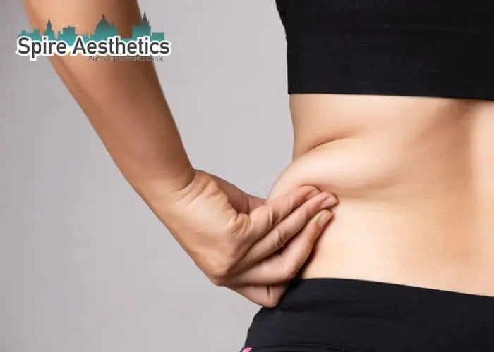 Image of woman pinching fat on their hips Preston. Fat Freezing treatment