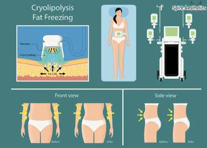 Fat freezing treatment Preston benefits for competitions to remove stubborn fat deposits.