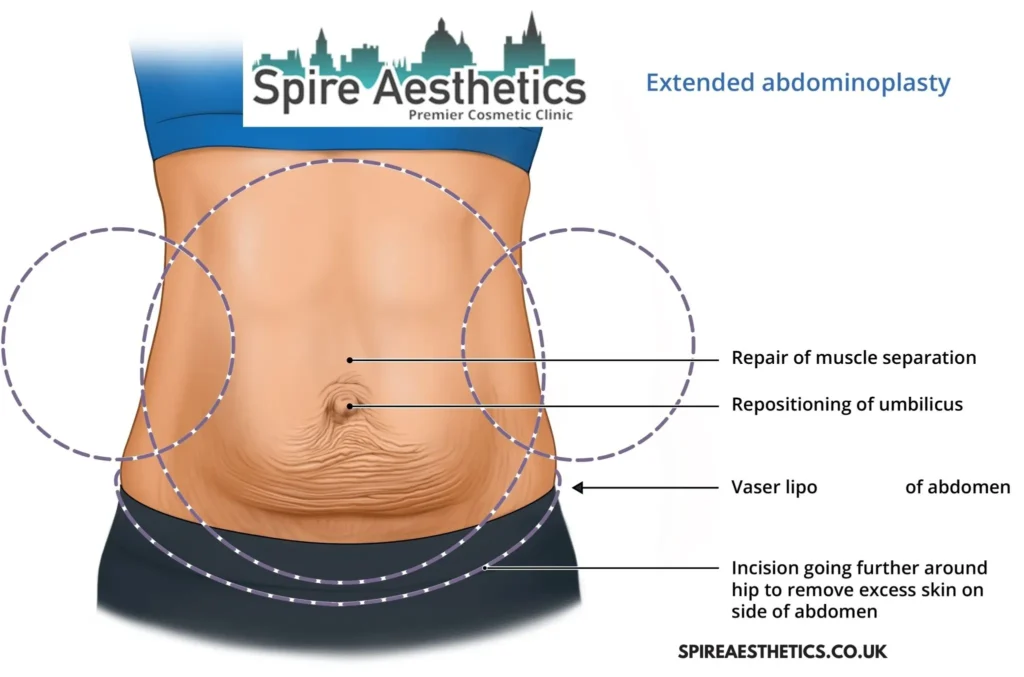 Understanding Loose Skin After Gastric Band Preston Surgery and HIFU Treatment