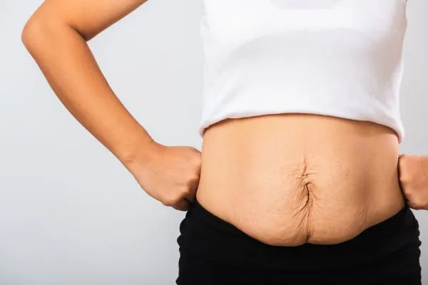 Image of a woman's stomach after weight loss with sagging skin following a gastric band Preston
