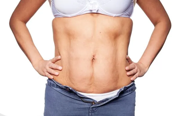 sagging skin on woman's stomach after weight loss injections Preston