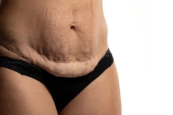 Image of womans stomach after weight loss injections Preston showing saggy skin