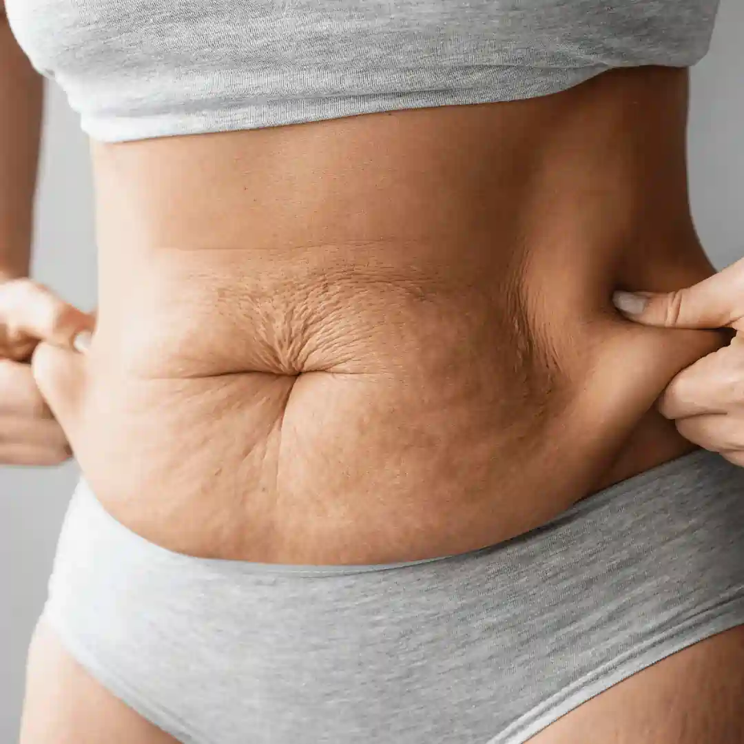 Is It Normal to Have Loose Skin After Pregnancy Preston?