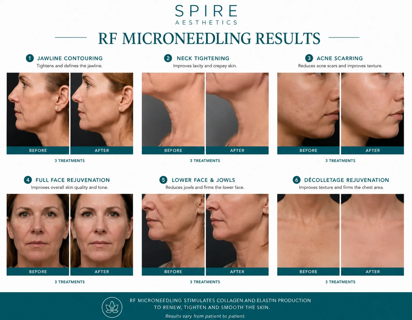 RF Microneedling Skin tightening Preston results