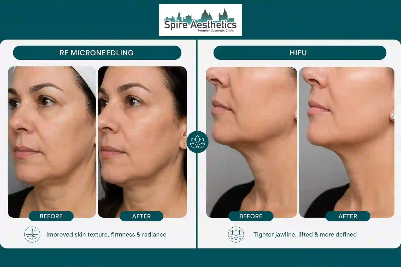 Can RF Microneedling and HIFU Be Combined Preston?