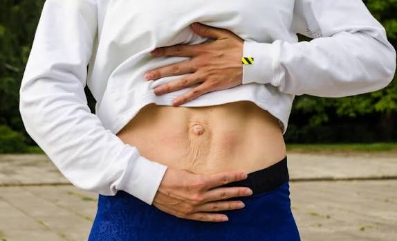 When Could Diastasis Recti Be the Missing Piece of the Puzzle Preston?