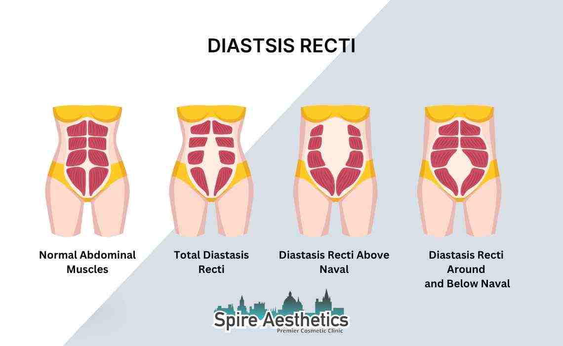 Is Non-Surgical Diastasis Recti Treatment Right for You? Common Concerns Answered Preston